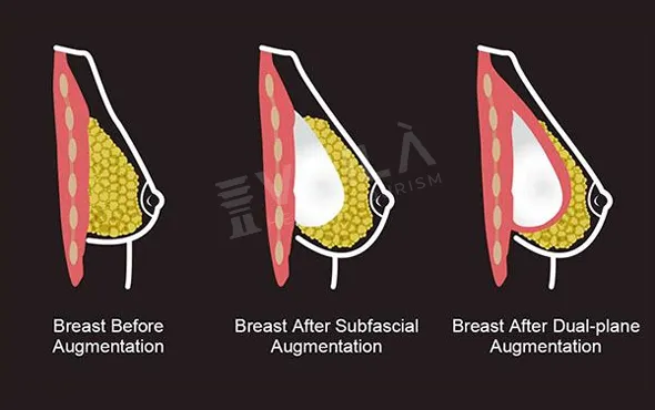Breast Augmentation - Voila Health Tourism - Dr Furkan Certel