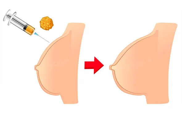 Breast augmentation with fat injection - Voila Clinic - Dr Furkan Certel