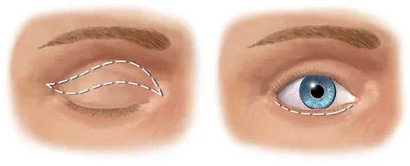 Blepharoplasty- Voila Clinic - Dr Furkan Certel