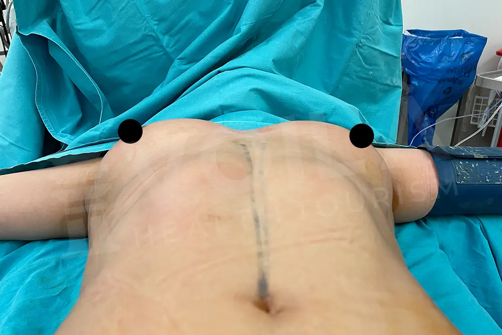 Breast Fat Injection - Voila Clinic - Dr Furkan Certel