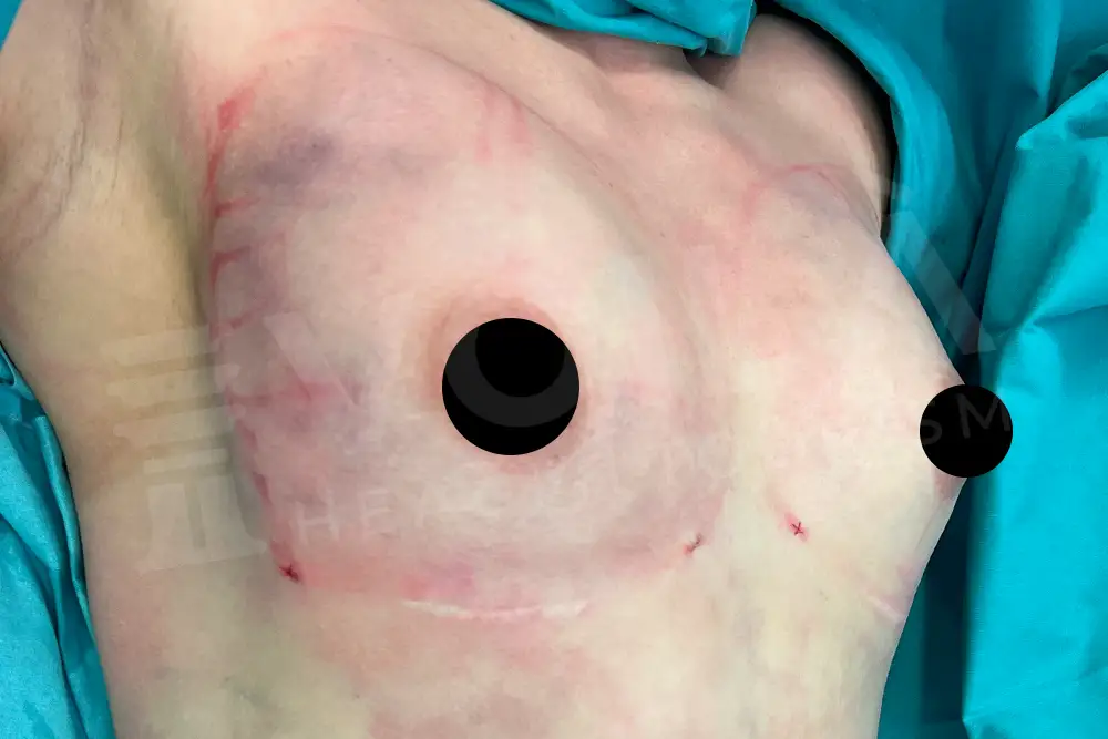 Breast Fat Injection - Voila Clinic - Dr Furkan Certel