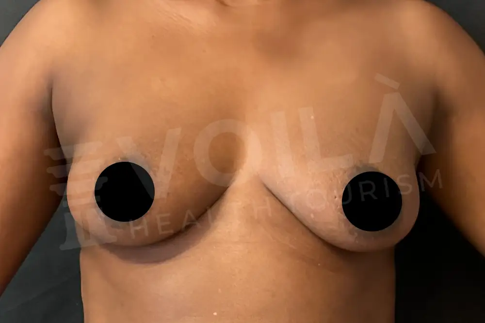Breast Fat Injection - Voila Clinic - Dr Furkan Certel