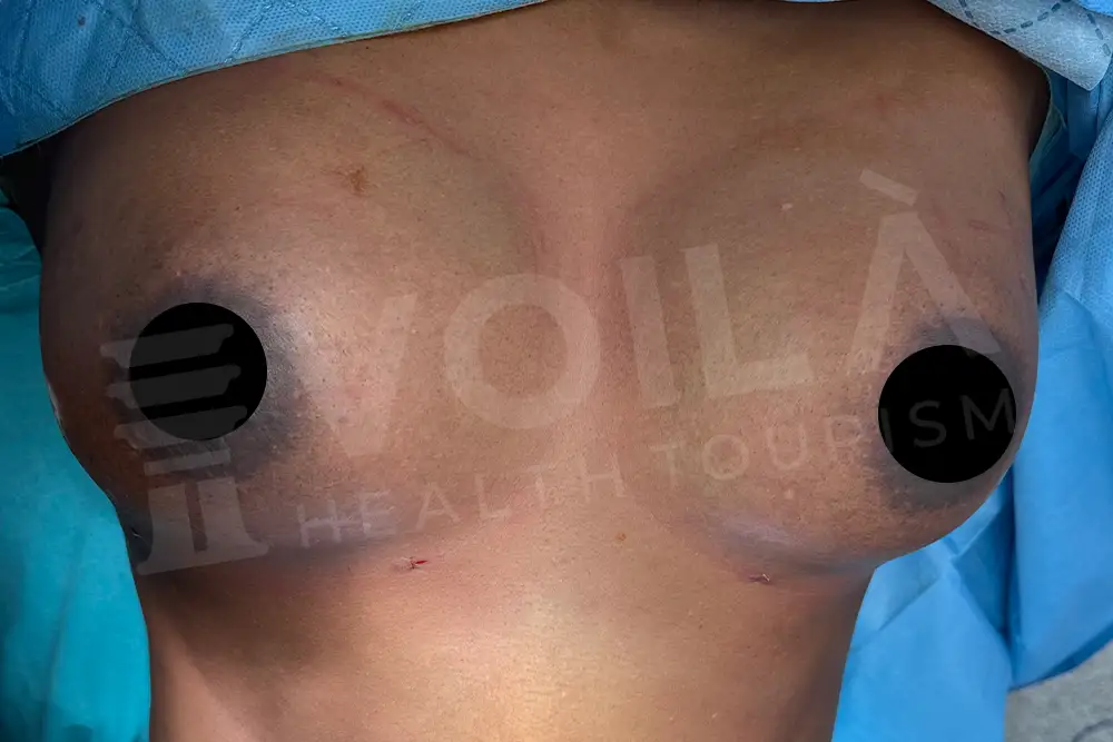 Breast Fat Injection - Voila Clinic - Dr Furkan Certel
