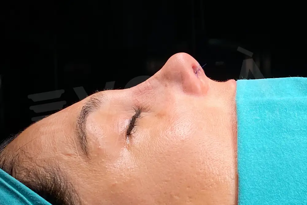 Rinoplasty - Voila health tourism - dr furkan certel