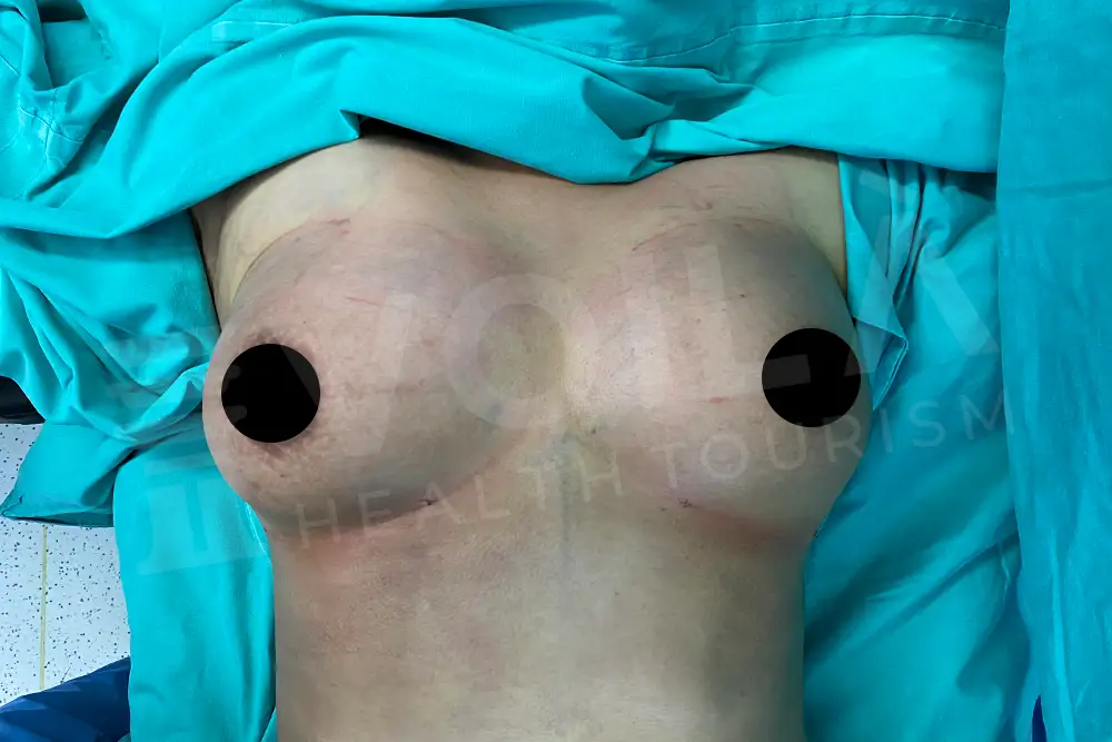 Breast Fat Injection - Voila Clinic - Dr Furkan Certel