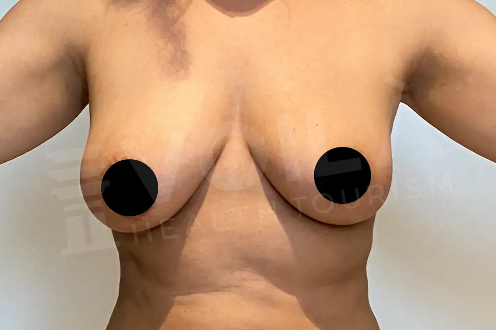 Breast Fat Injection - Voila Clinic - Dr Furkan Certel