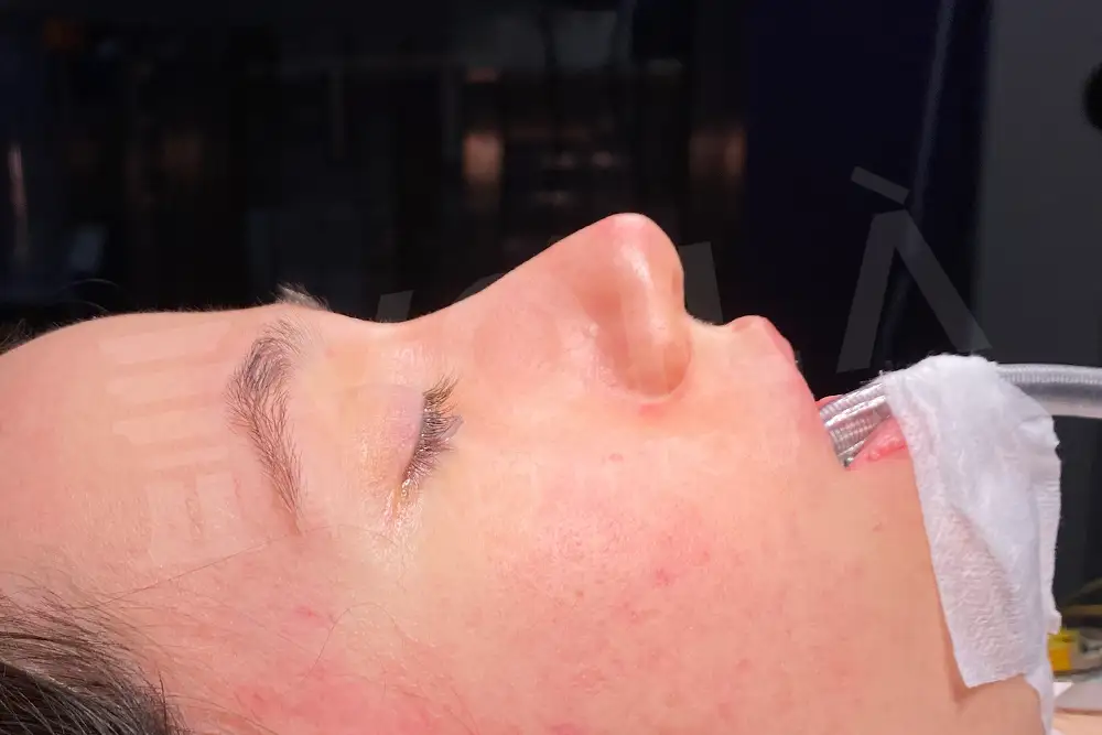 Rinoplasty - Voila health tourism - dr furkan certel