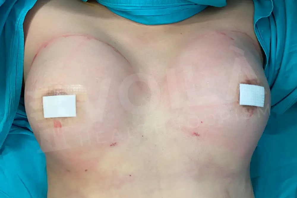Breast Fat Injection - Voila Clinic - Dr Furkan Certel
