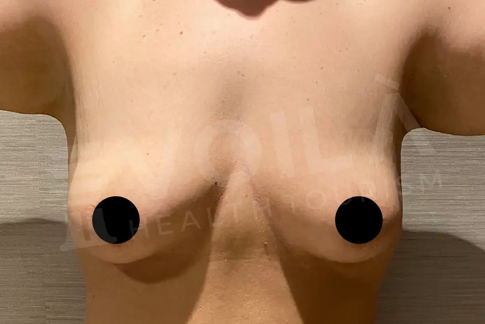 Breast Fat Injection - Voila Clinic - Dr Furkan Certel