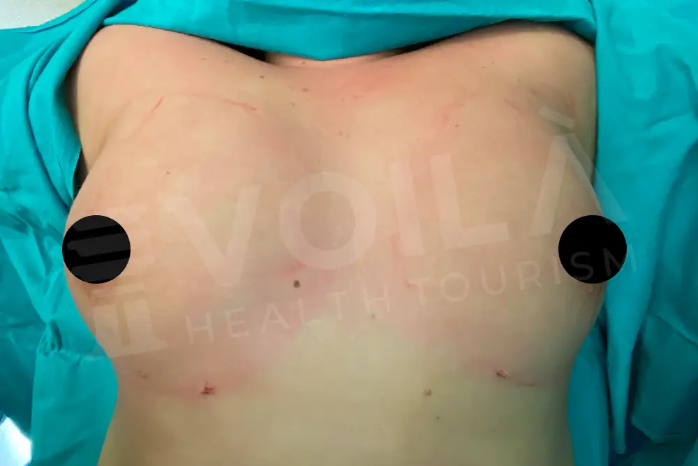 Breast Fat Injection - Voila Clinic - Dr Furkan Certel