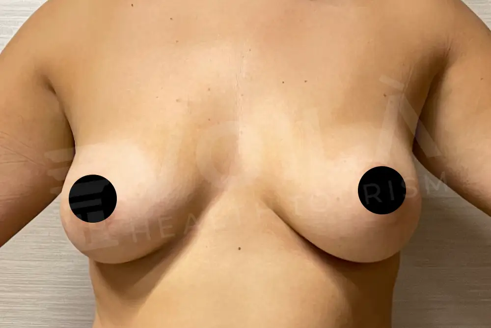 Breast Fat Injection - Voila Clinic - Dr Furkan Certel