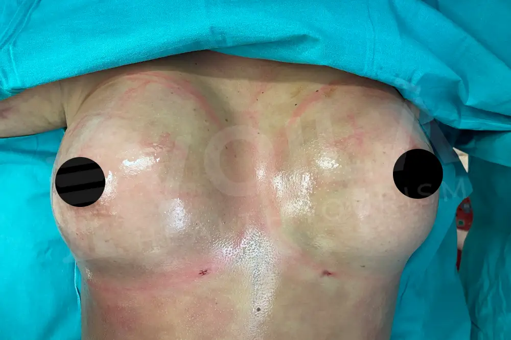 Breast Fat Injection - Voila Clinic - Dr Furkan Certel