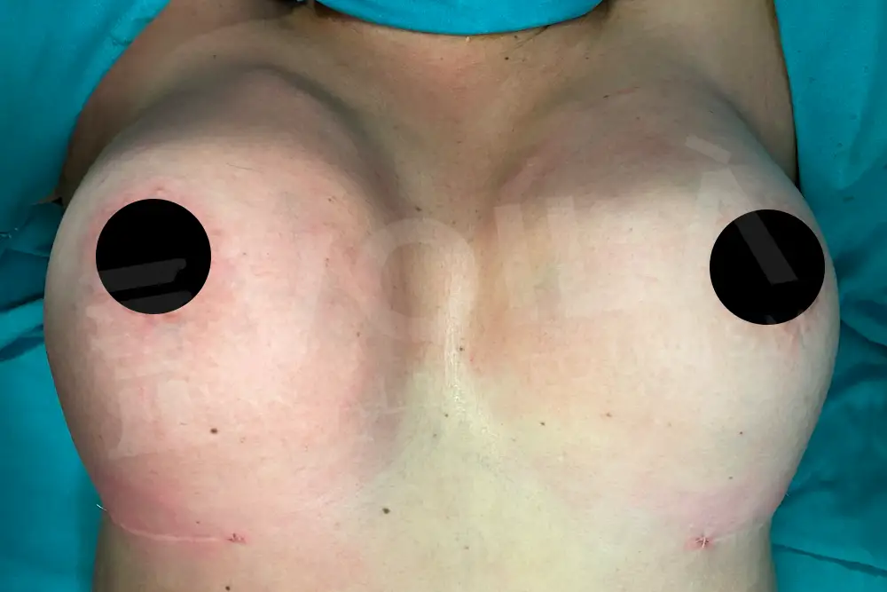 Breast Fat Injection - Voila Clinic - Dr Furkan Certel