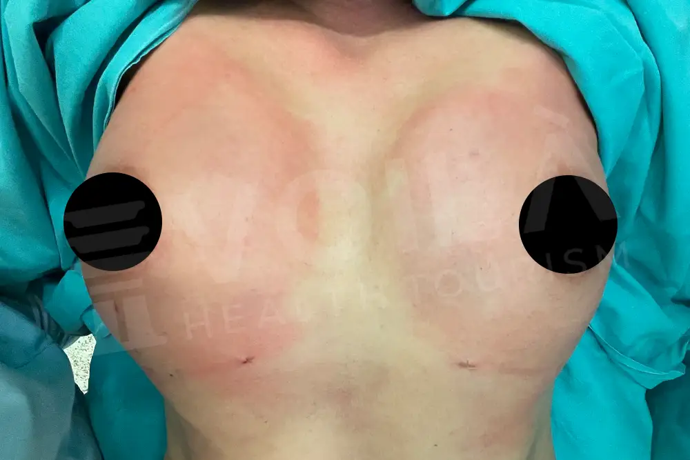 Breast Fat Injection - Voila Clinic - Dr Furkan Certel