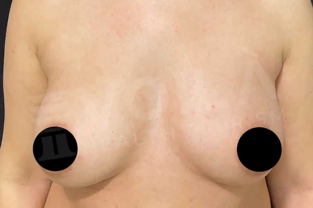 Breast Fat Injection - Voila Clinic - Dr Furkan Certel