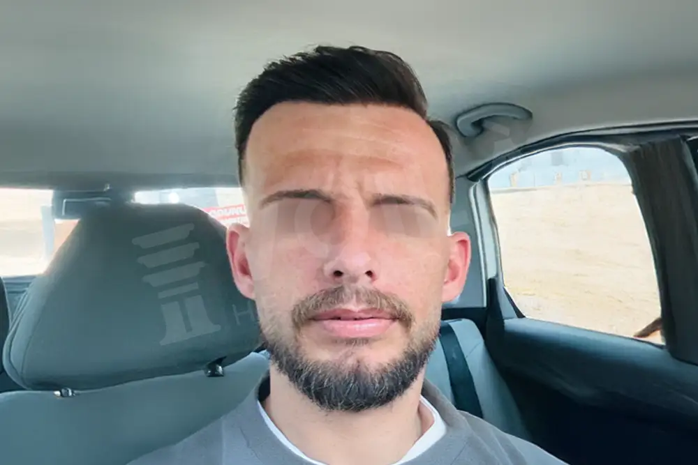 Hair transplant - Voila Clinic