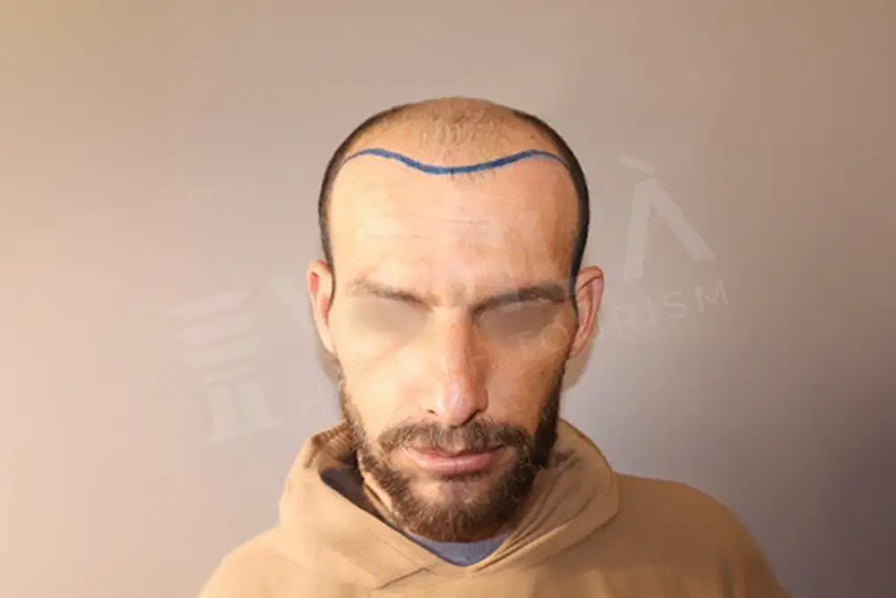 Hair transplant - Voila Clinic