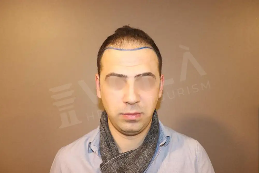 Hair transplant - Voila Clinic