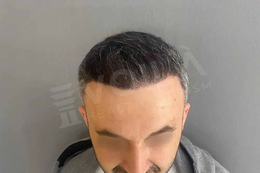 Hair transplant - Voila Clinic