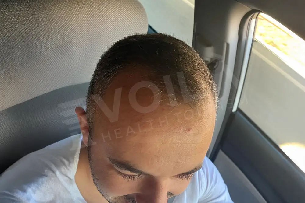 Hair transplant - Voila Clinic
