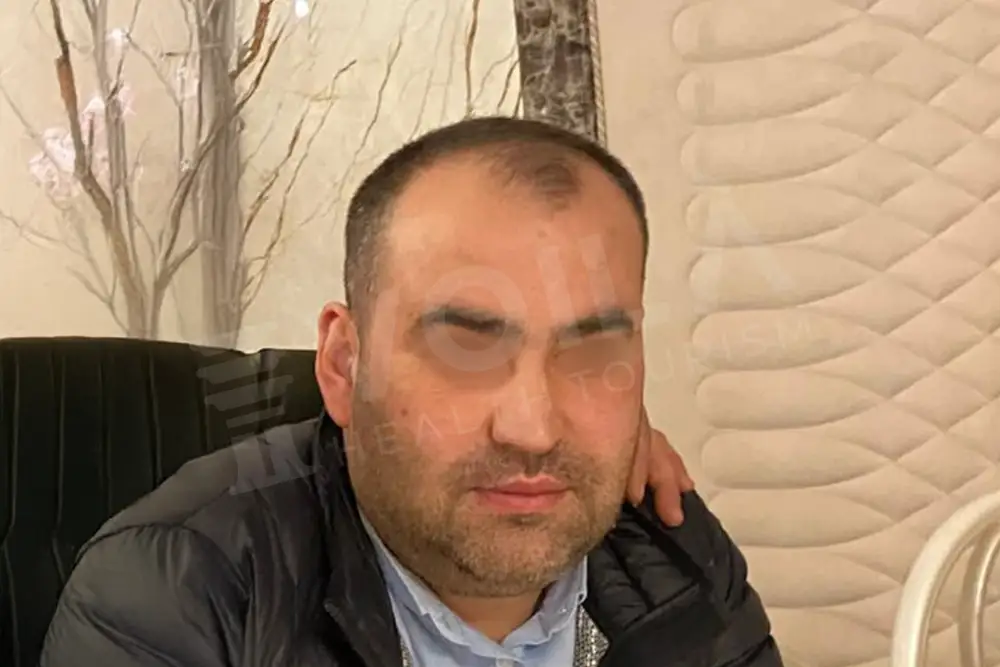 Hair transplant - Voila Clinic