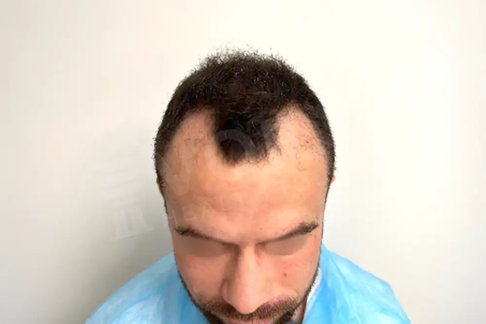Hair transplant - Voila Clinic