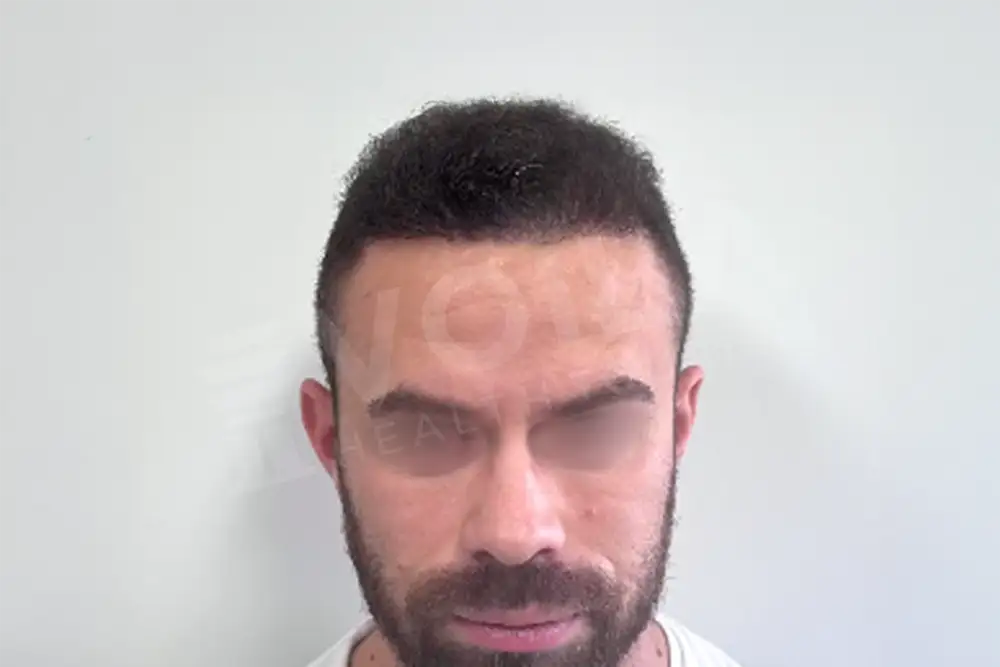 Hair transplant - Voila Clinic