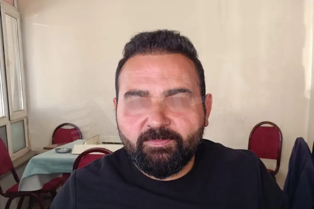 Hair transplant - Voila Clinic