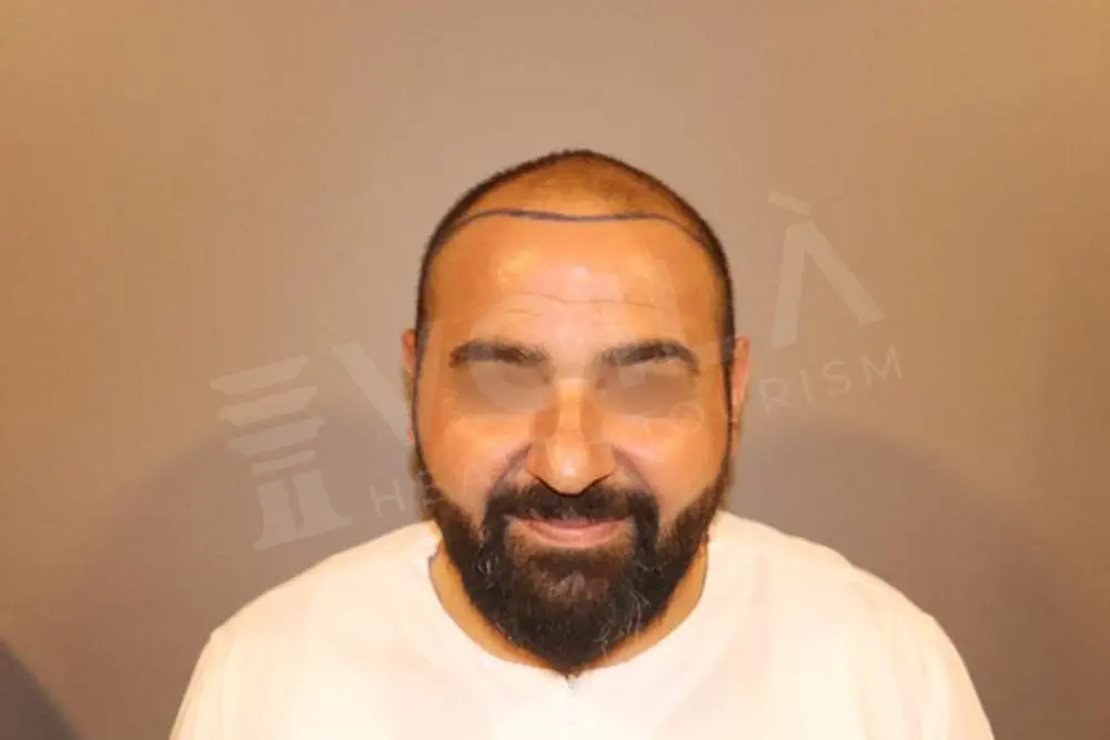 Hair transplant - Voila Clinic