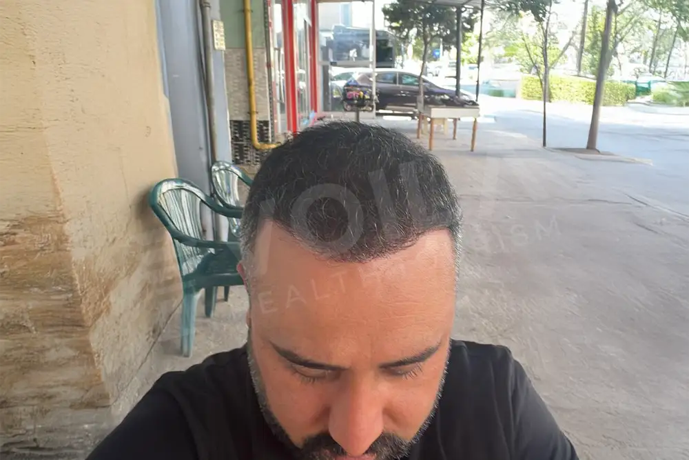 Hair transplant - Voila Clinic