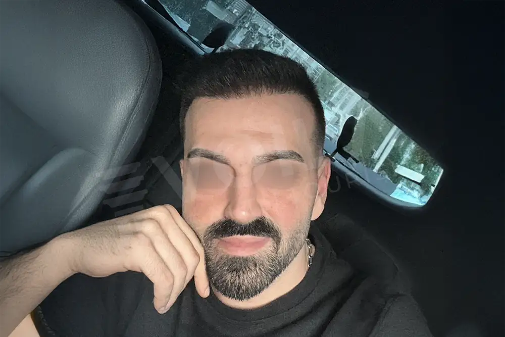 Hair transplant - Voila Clinic