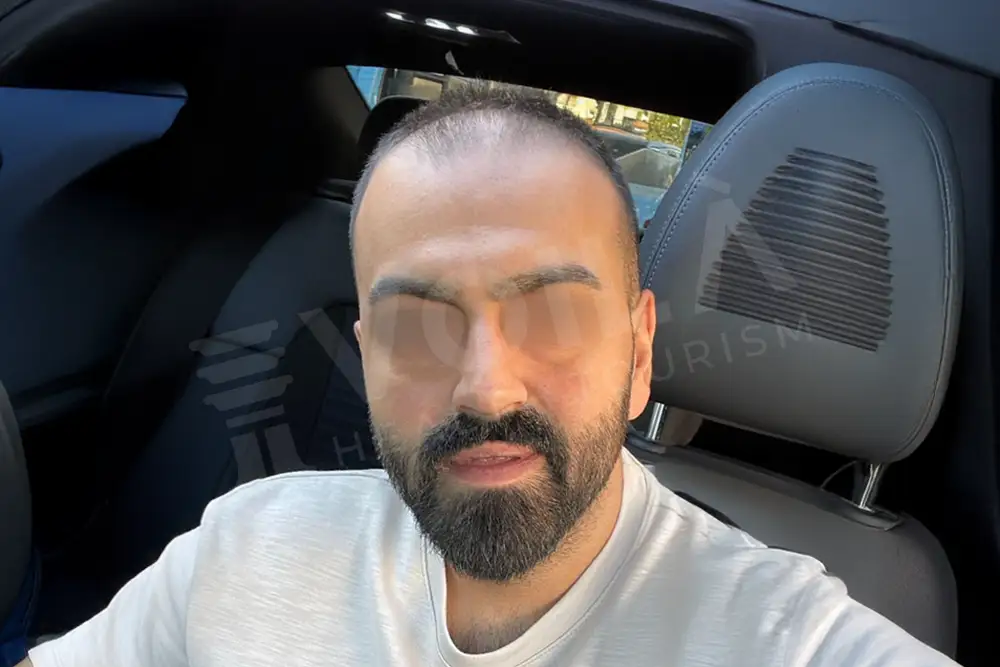 Hair transplant - Voila Clinic