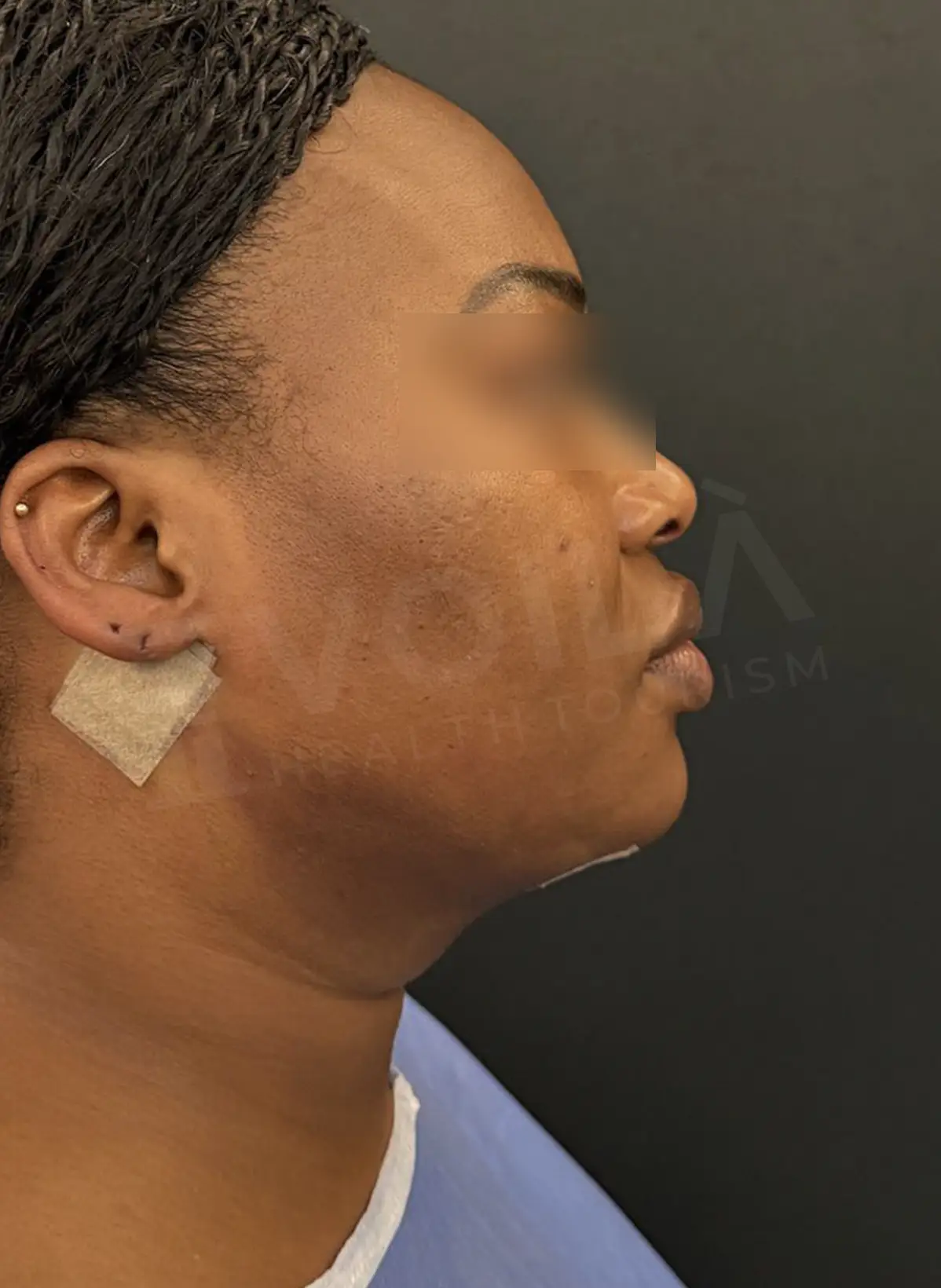 Double Chin Lipo - Voila Clinic