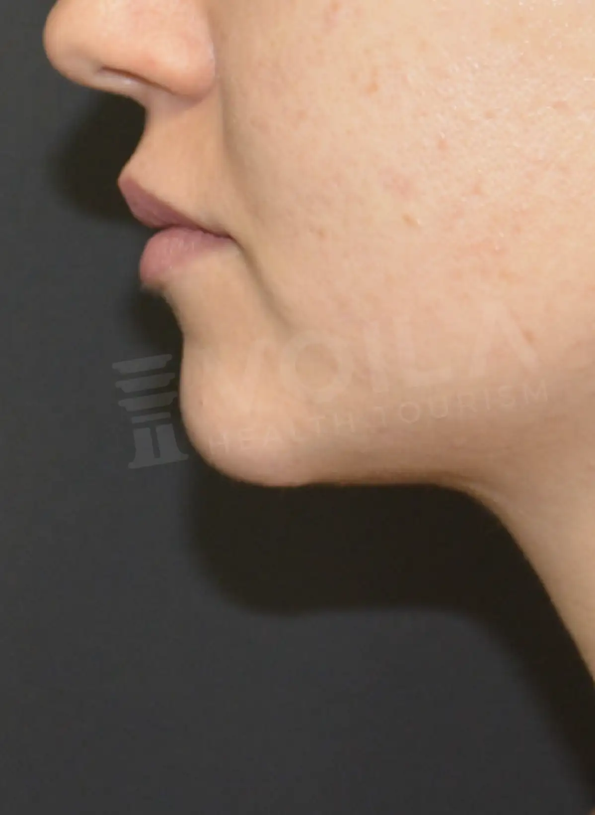 Double Chin Lipo - Voila Clinic