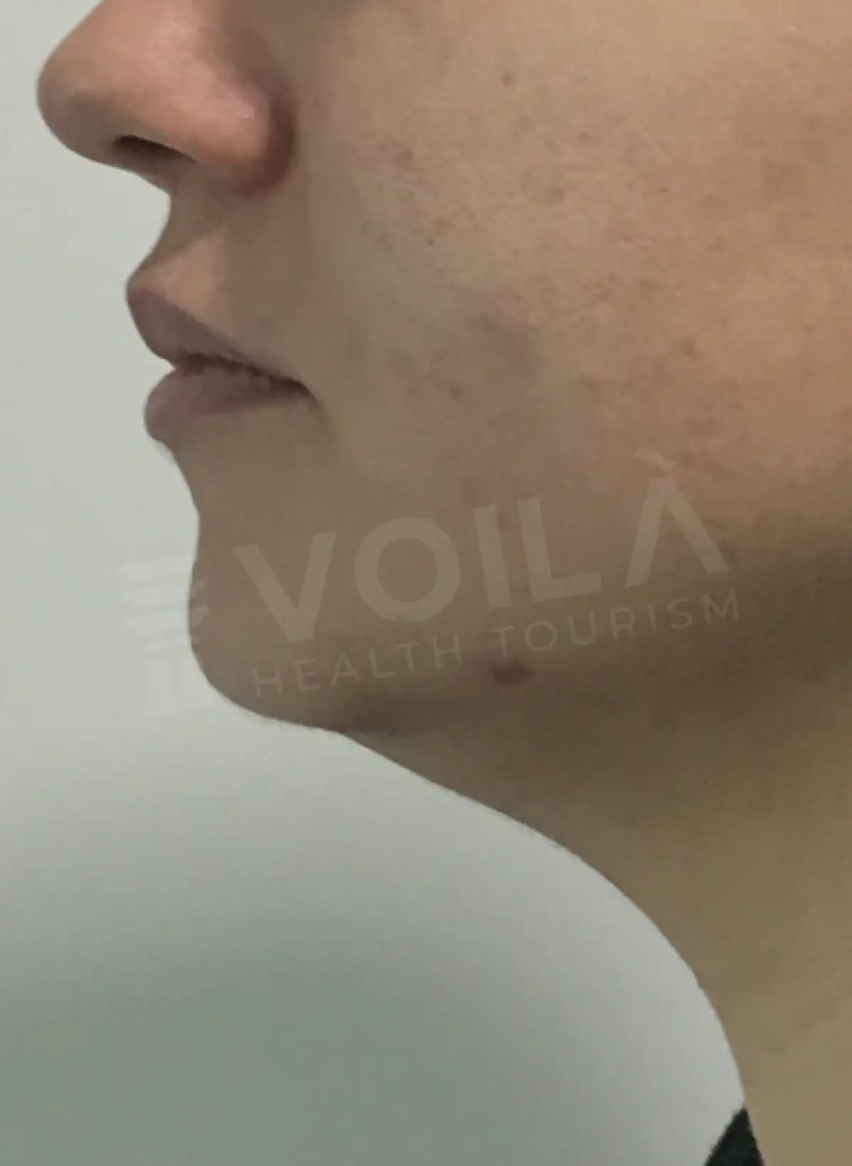 Double Chin Lipo - Voila Clinic