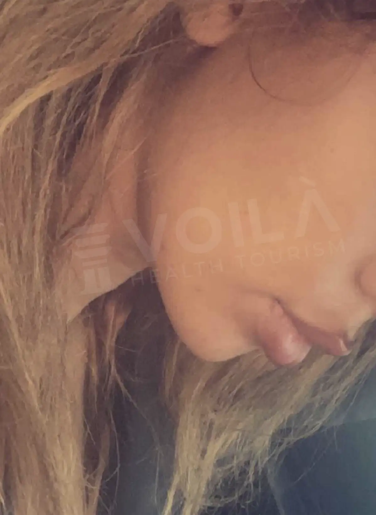 Double Chin Lipo - Voila Clinic