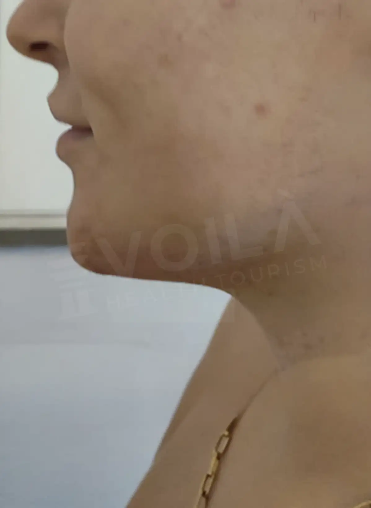 Double Chin Lipo - Voila Clinic