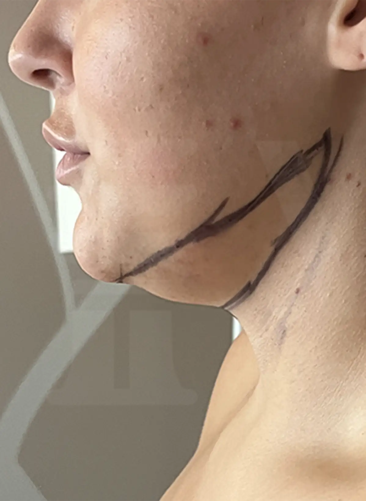 Double Chin Lipo - Voila Clinic