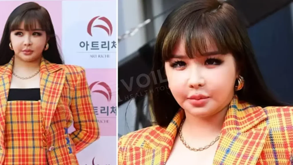 Park Bom before and after - Voila Clinic - Dr Furkan Certel