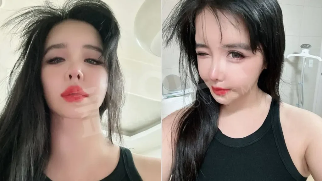 Park Bom before and after - Voila Clinic - Dr Furkan Certel