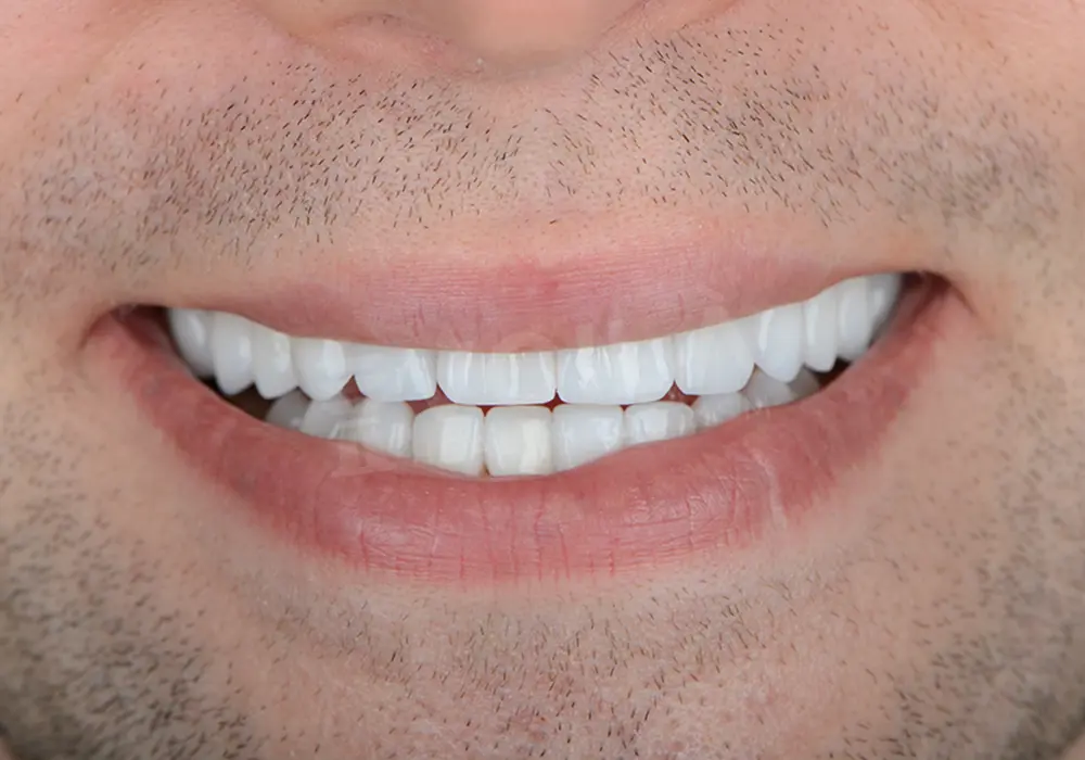 EMAX VENEERS - Voila Health