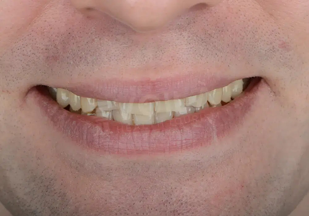 EMAX VENEERS - Voila Health
