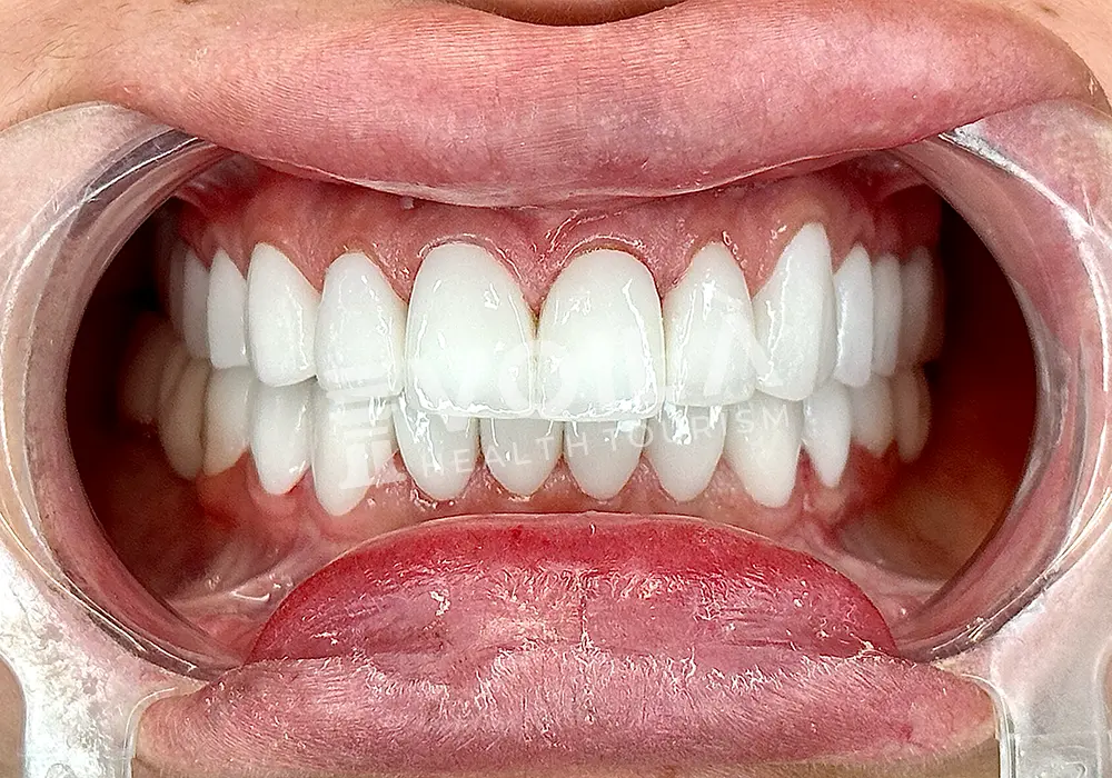 EMAX VENEERS - Voila Health