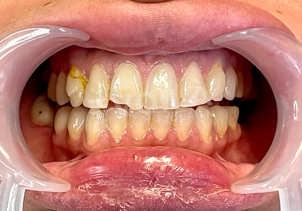 EMAX VENEERS - Voila Health