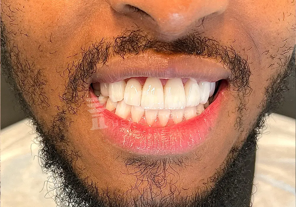 EMAX VENEERS - Voila Health