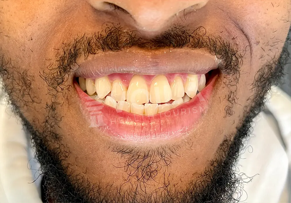 EMAX VENEERS - Voila Health