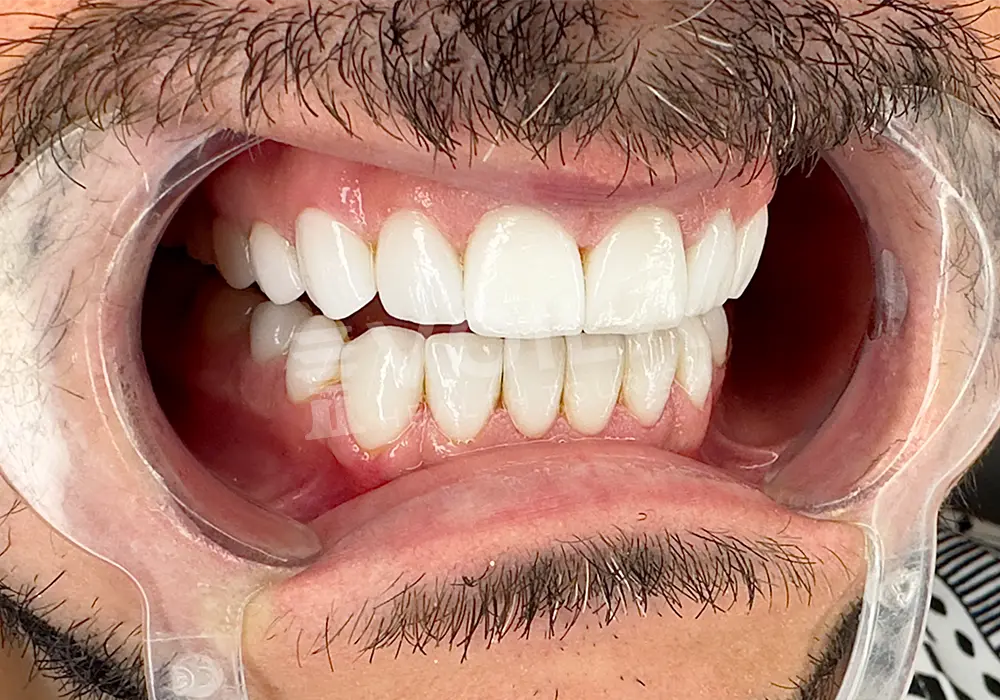 EMAX VENEERS - Voila Health