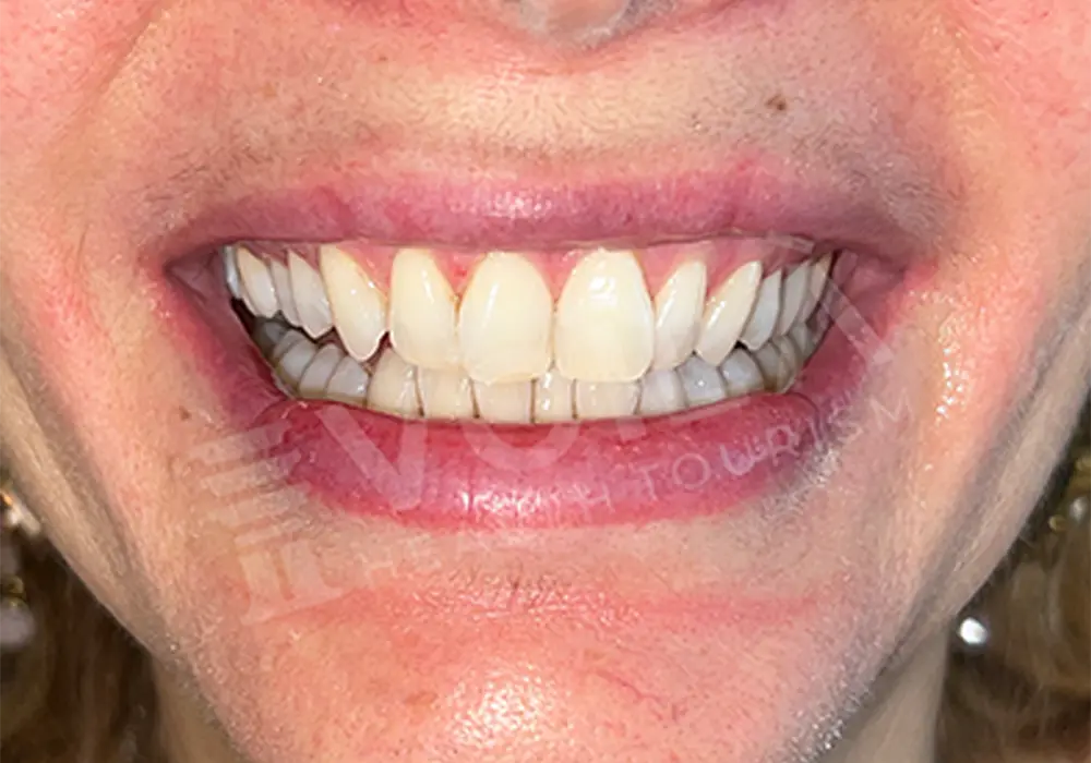 Teeth Whitening - Voila Health Tourism - Volia Clinic - Dr Furkan Certel