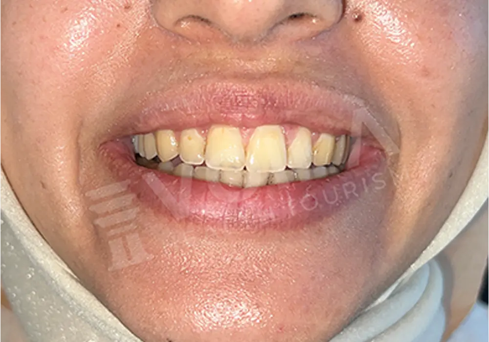 Teeth Whitening - Voila Health Tourism - Volia Clinic - Dr Furkan Certel