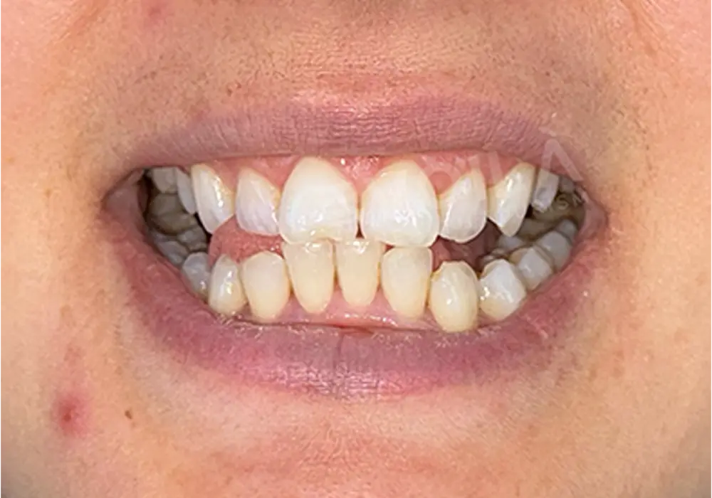 Teeth Whitening - Voila Health Tourism - Volia Clinic - Dr Furkan Certel